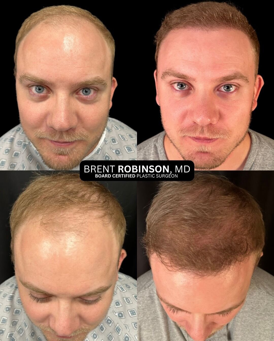 Hair Transplant Gallery Before & After Image