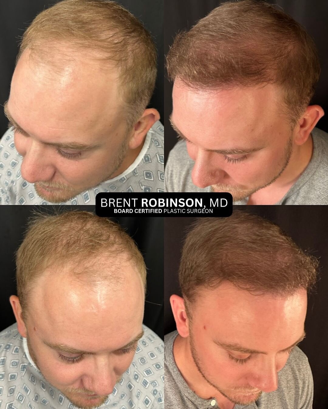 Hair Transplant Gallery Before & After Image