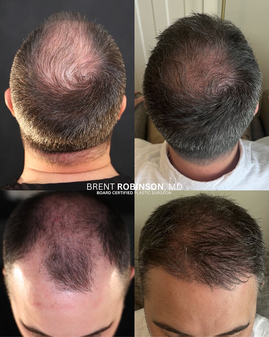 Hair Transplant Gallery Before & After Image