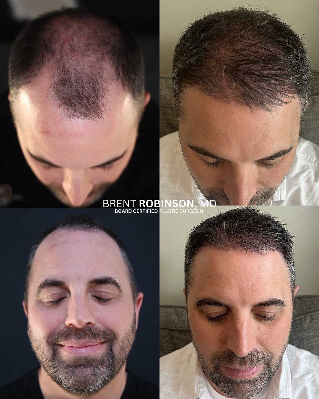 Hair Transplant Gallery Before & After Image