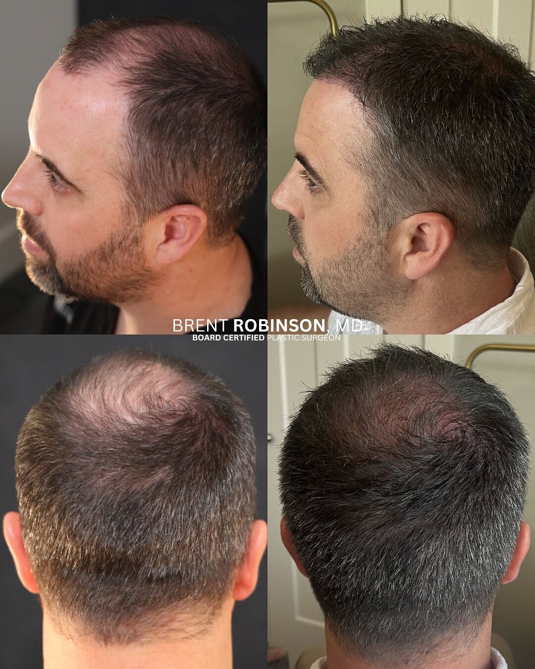 Hair Transplant Gallery Before & After Image